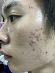 イソトレチノイン治療前のニキビ肌の写真